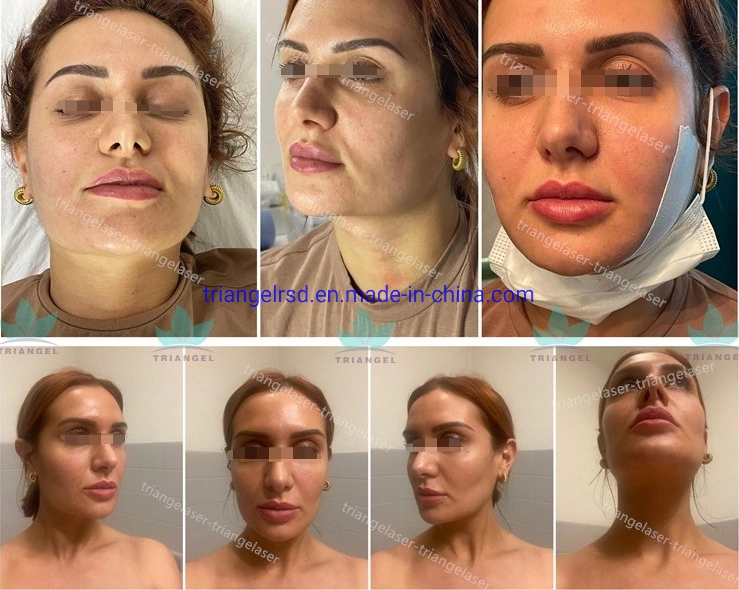 Liposucción láser Liposucción facial Lipo 1470 Cirugía Lipo Eliminación de grasa instrumento