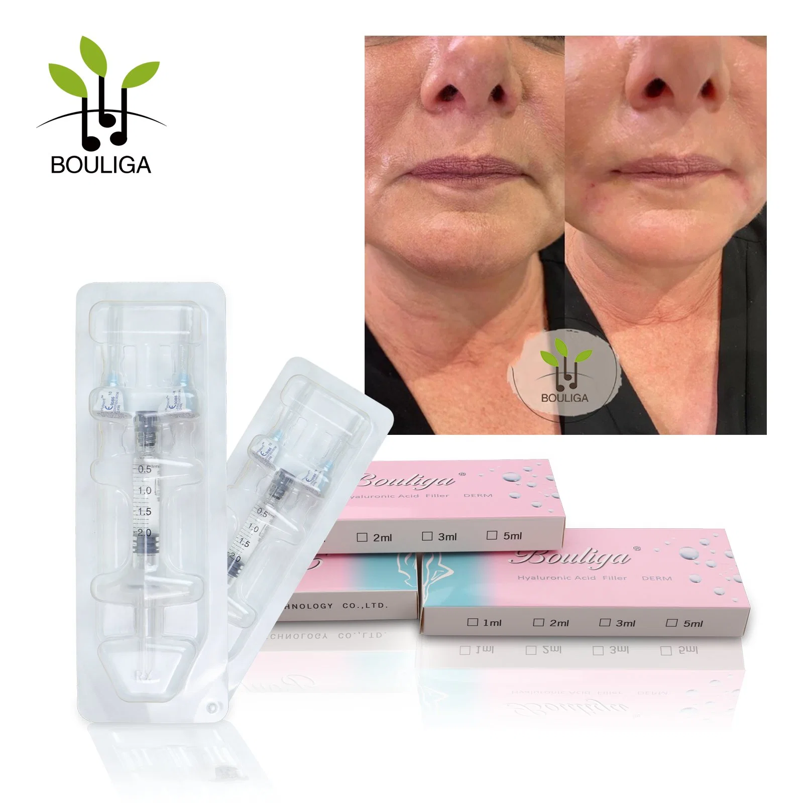 Hyaloronic Acid Injection 2ml Cross Linked Derm Hyaluronic Acid for Plumps up Lips