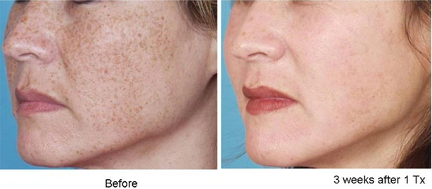 Hyperpigmentation Hydroquinone Vitamin C Serum Mesotherapy Dark Spot Remove Spot Removal Serum