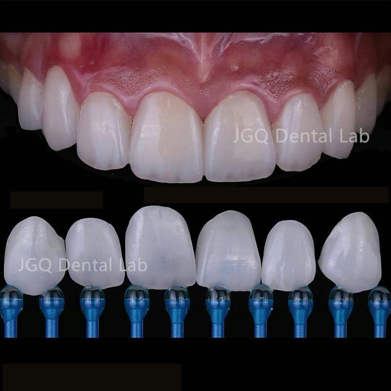 High Precise Dental Implant Tooth Full Ceramic Bridge with Pure Titanium Abutment