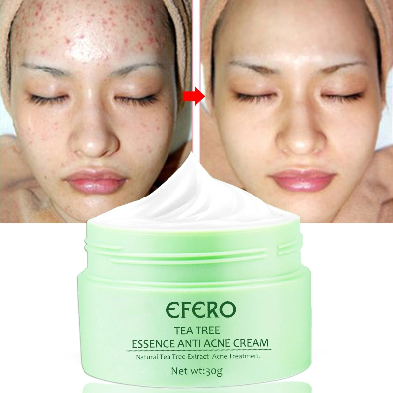 Tea Tree Acne Creme Hidratante cicatrizes cabeça negra extracção tratamento para acne pele creme embranquecimento gelado creme facial cuidado da pele