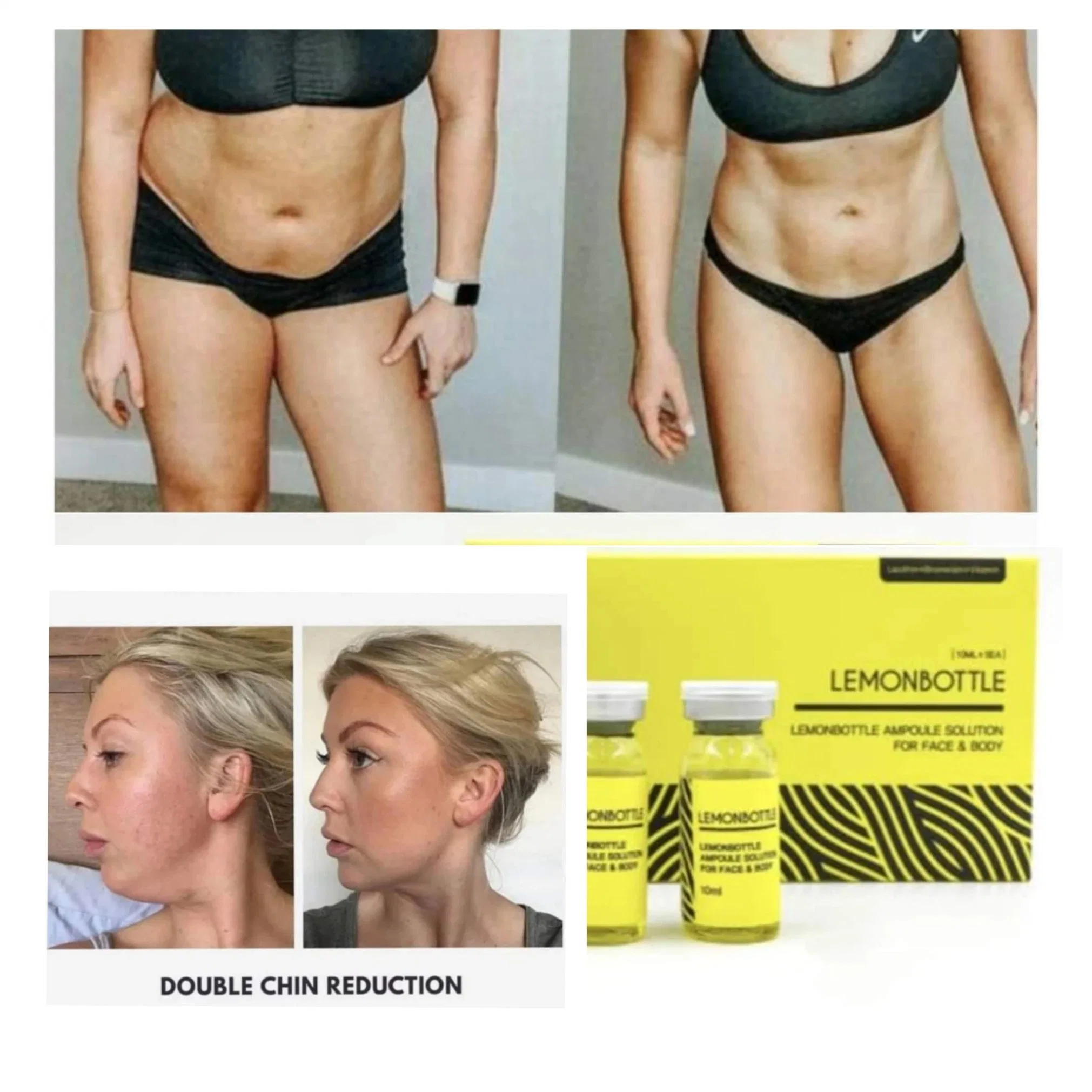 Kybella Allergan Belkyra Fat Dissolver Results Swelling for Double Chin Reduction Nom-Surgical Neck Fat Loss Weight Injection Kabelline Lemonbottle Ozempics