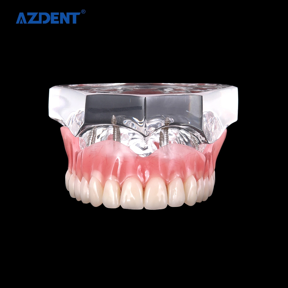 High quality/High cost performance CE Certified Standard Plastic Dental Implant Teeth Model