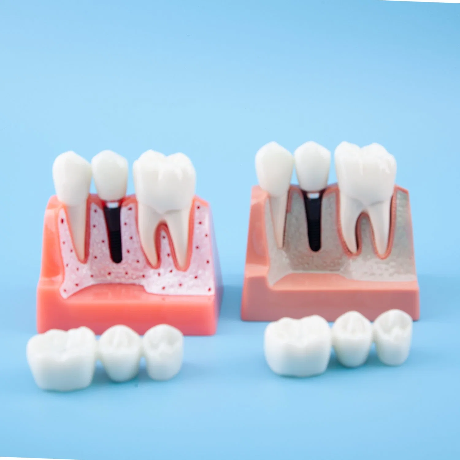 4 Mal Zahnimplantat Studie Analyse Harz Abnehmbare Menschliche Teeth Training Modell