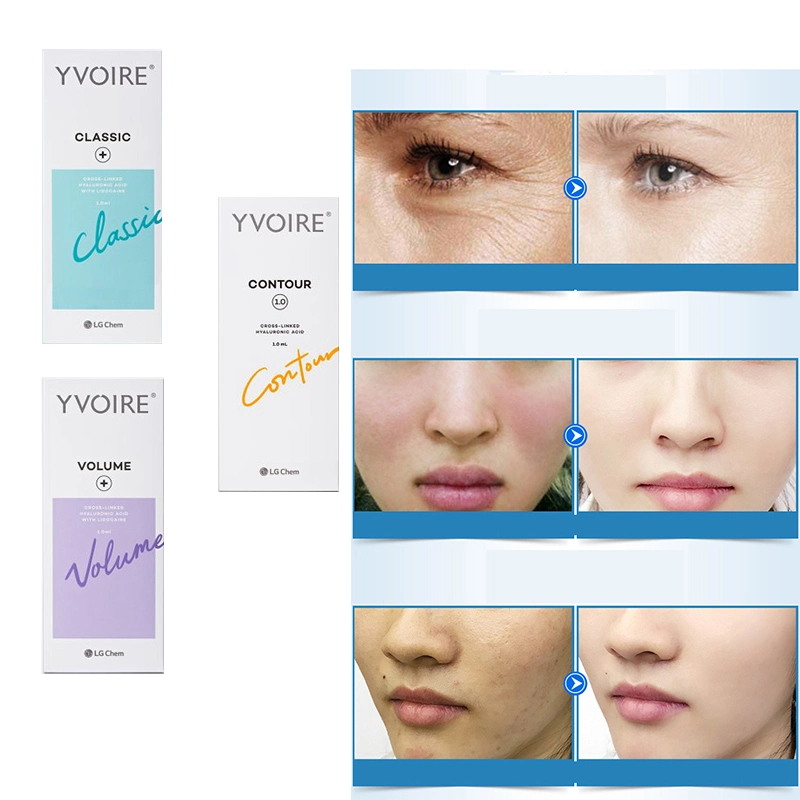 Yvoire Classic / Volume / Contour Injection Modified Sodium Hyaluronate Gel Hyaluronic Acid Dermal Filler Yvoire Neuramis Rejeunesse Dermal Filler