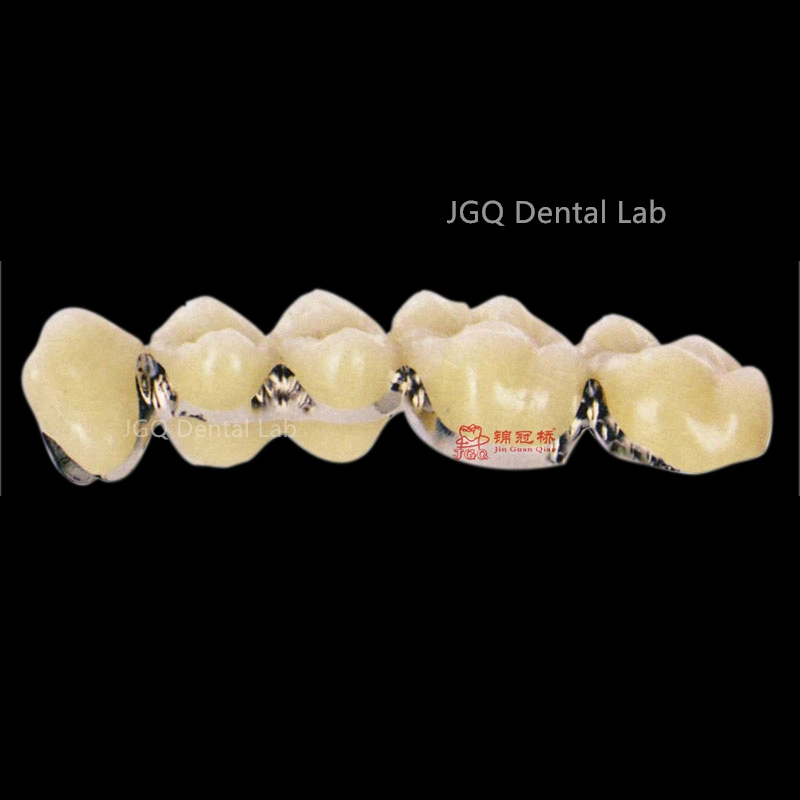 Dentures Teeth Metal Porcelain Ceramic Implant Pfm Crowns and Bridge From China Dental Lab