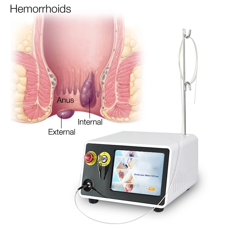 980nm 1470nm pilas de hemorroides fístula ablación con láser Proctología Anorrectal con láser Láser de hemorroides en Proctología tratamiento de hemorroides con láser quirúrgico anorrectal