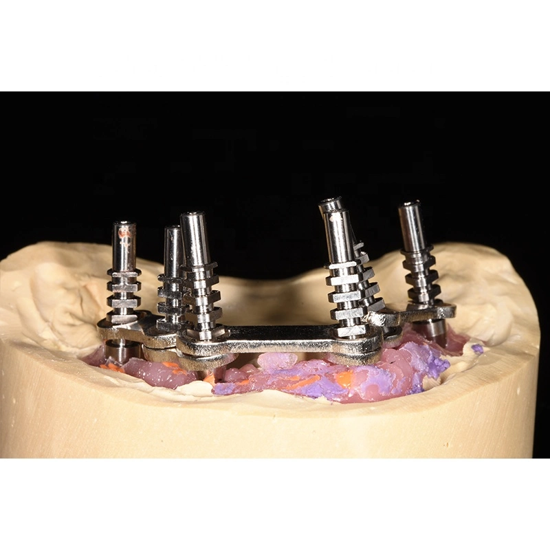 All on 4 Dental Prosthesis Metal Implant Supported Overdenture Bar