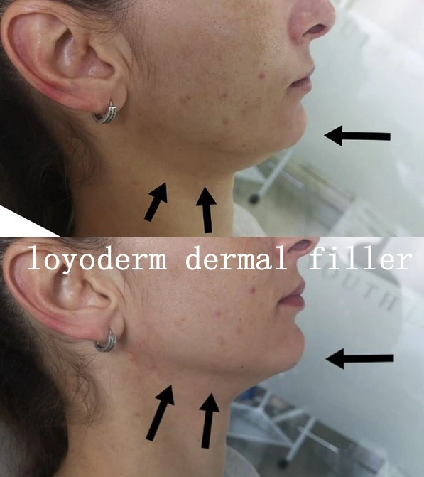 Loyoderm Injection ácido Hialurónico Dermal Filler 1ml 2 ml 10ml Arrugas antiedad