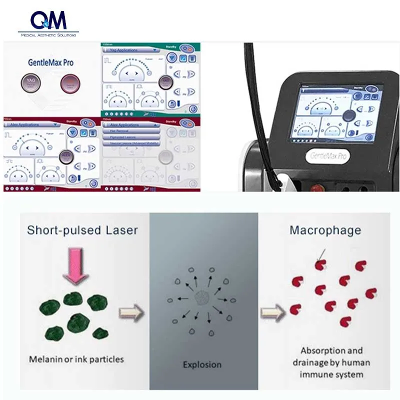 Système laser d'épilation Alexandrite à diode 755nm de qualité supérieure QM