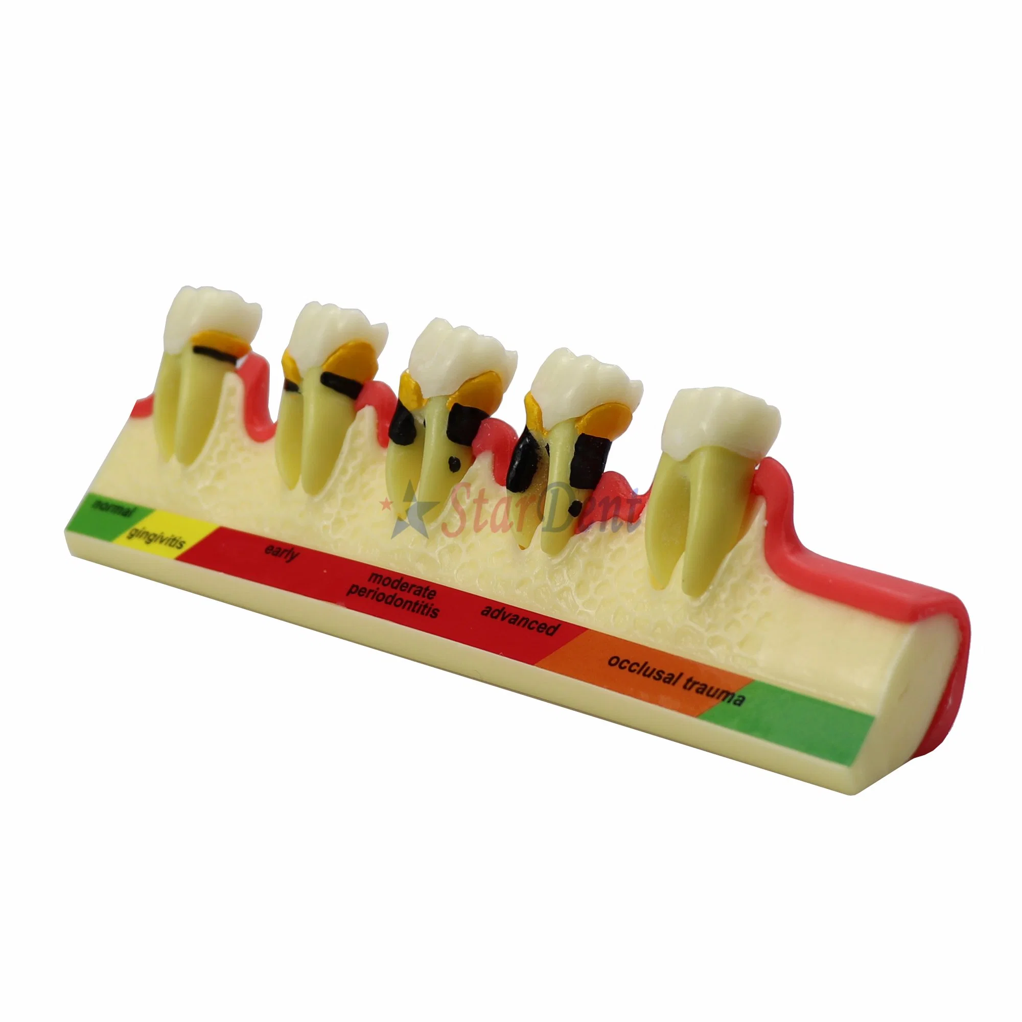 Dental Periodontal Disease Model Demonstrates The Progress of Periodontal Disease Dental Resin Teeth for Teaching