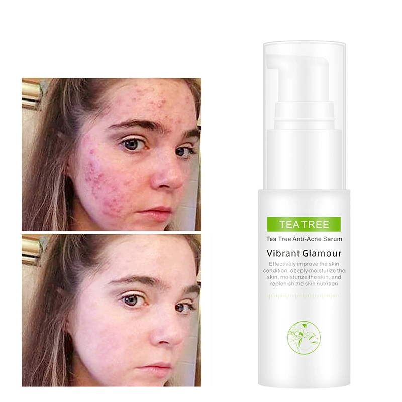 Viva el glamour de Aceite de Árbol de Té de suero de la cara Acné tratamiento anti acné cicatriz extracción reducir poros blanqueadora Crema antienvejecimiento Skin Care