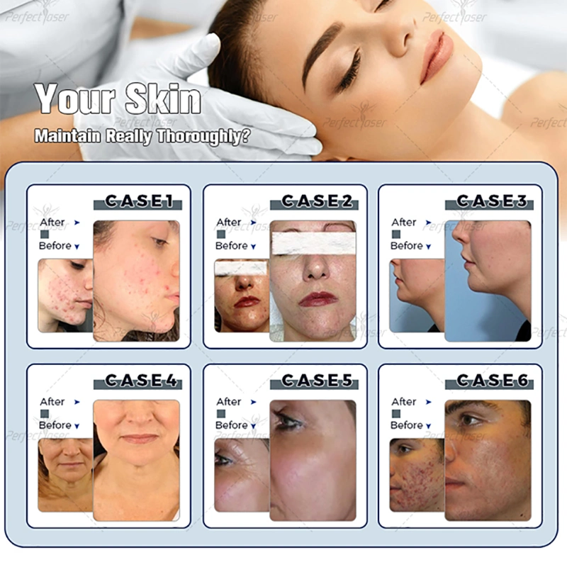 FDA Hydra Oxygen Facial Fine Lines Removal Skin Care Device