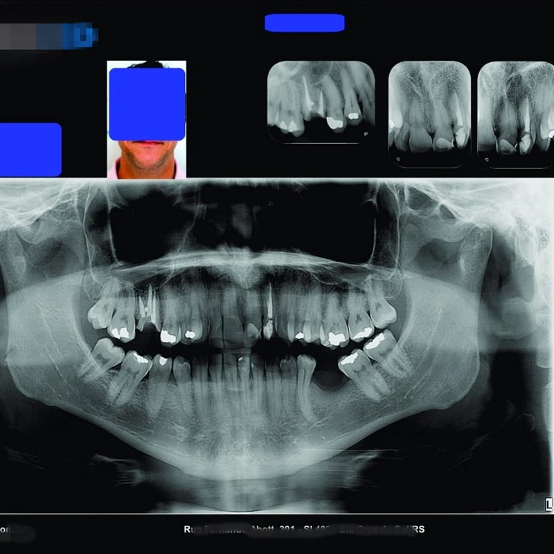 White Opaque Medical X-ray Film Image Printing Film for Epson &amp; Canon Inkjet Printer