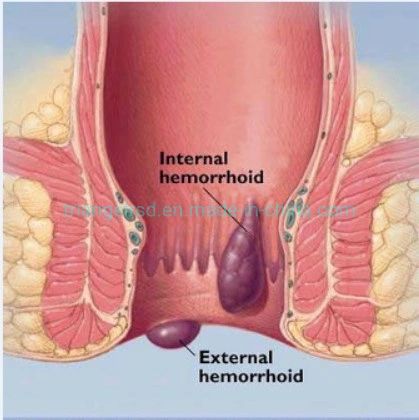 Hola II 980nm +1470nm Diode Laser for Hemorrhoids Surgery