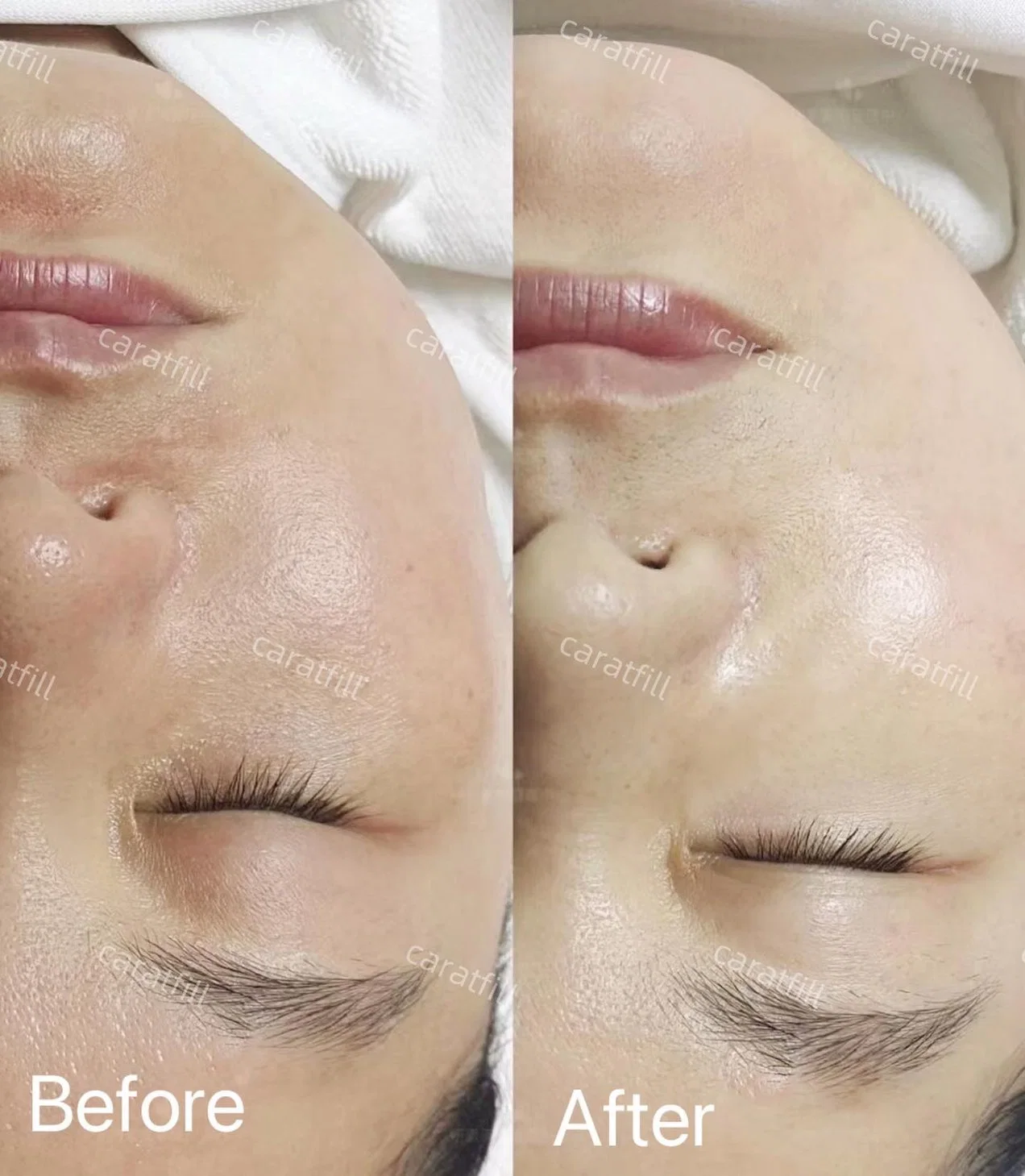 Korean Caratfill Skin Booster Pn + Ha Filler Injection