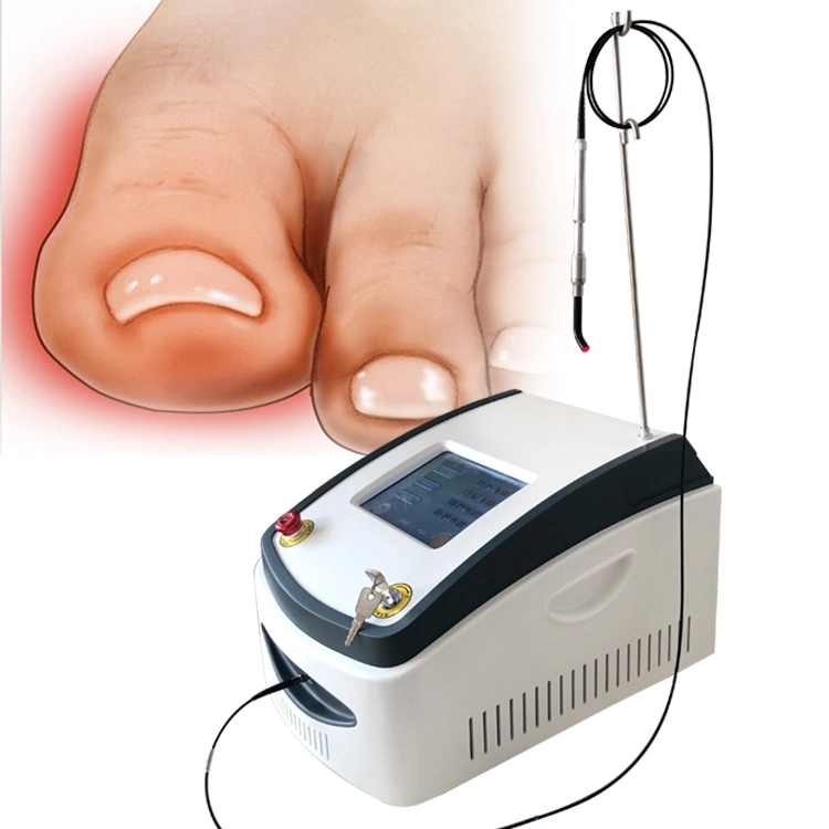 Triangel Laseev 980nm pour Nail champignon/Podiatry/Plantar Fascitis/verrues de pied et Onychomycosis thérapie Podiatrie podiatre professionnel utilisation!