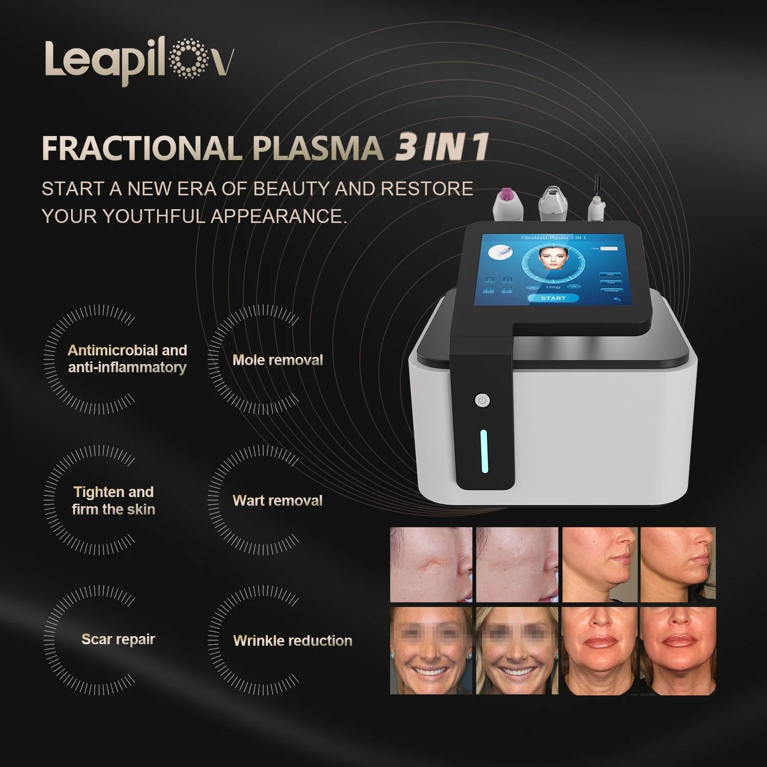 3 en 1 la extracción de extracción del SCAR efectos tonificantes pluma Plasma