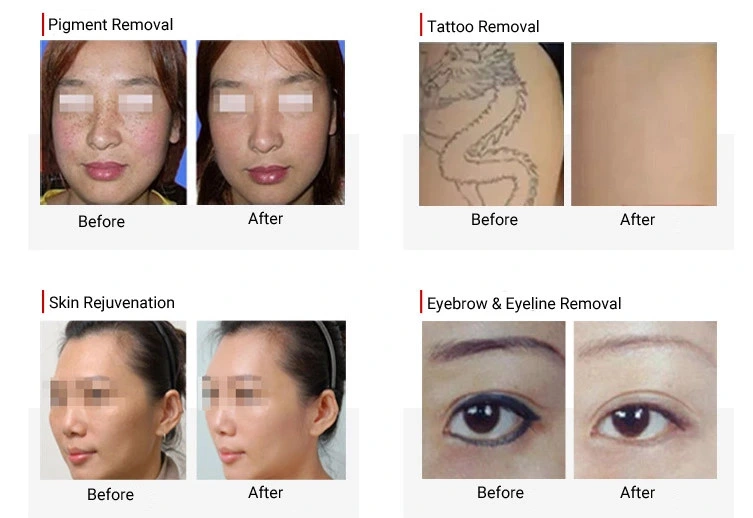 Eyebrow Tattoo Removal Costfull Tattoo Removalrenewal Tattoo Removal