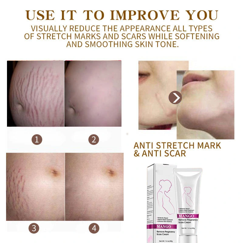 Etiqueta personalizada embarazo Anti-Stretch Marca Removal Crema mejor Natural