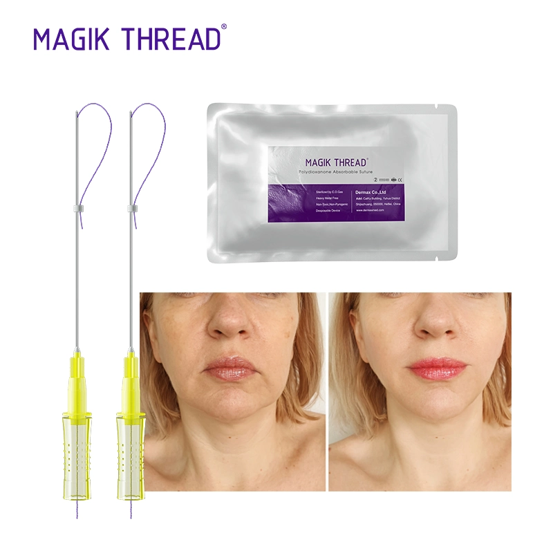 Magik Thread Disposable Medical Supplies Tear Trough Pdo Threads for Face Lifting