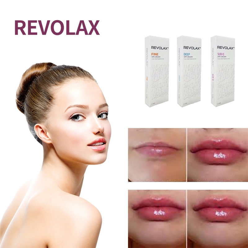 High Quality Revolax Fine Deep Volume 1ml Hyaluronic Acid Injectable Dermal Filler Lip Filler Nose Chin Cheek Filling