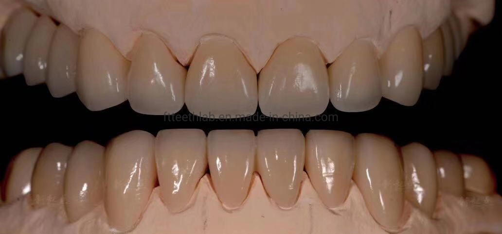 Material dentário coroa de Suprimentos Laboratório Dental Produtos Ortodontia ultra naturais folheados finos para sorriso perfeito