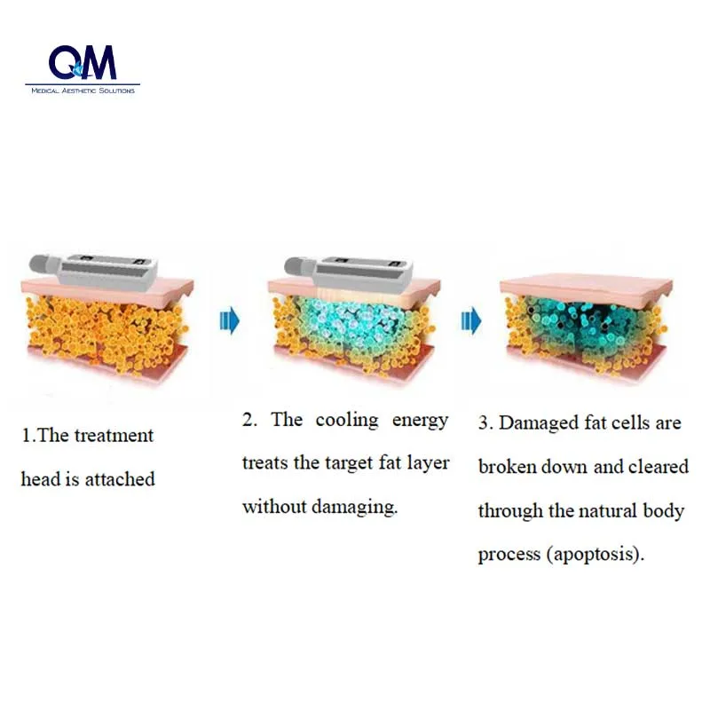 Congélation de la graisse perte de poids Cryolipo Cryo appareil de congélation de la graisse 8 Poignées de travail simultanées