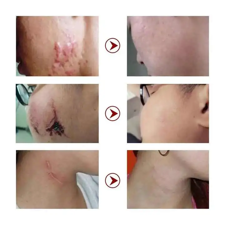 Skin Repair for Surgical Scars Effective Remove Cream Medical Grade Silicone Scar Gel