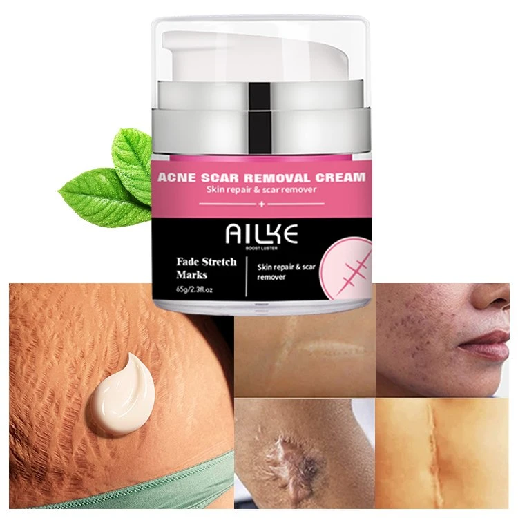 Ailke Smooth Skin Plant Extract Hydrolyzed Collagen Lightening Anti-Acne Removing Stretch Acne Scar Removal Cream