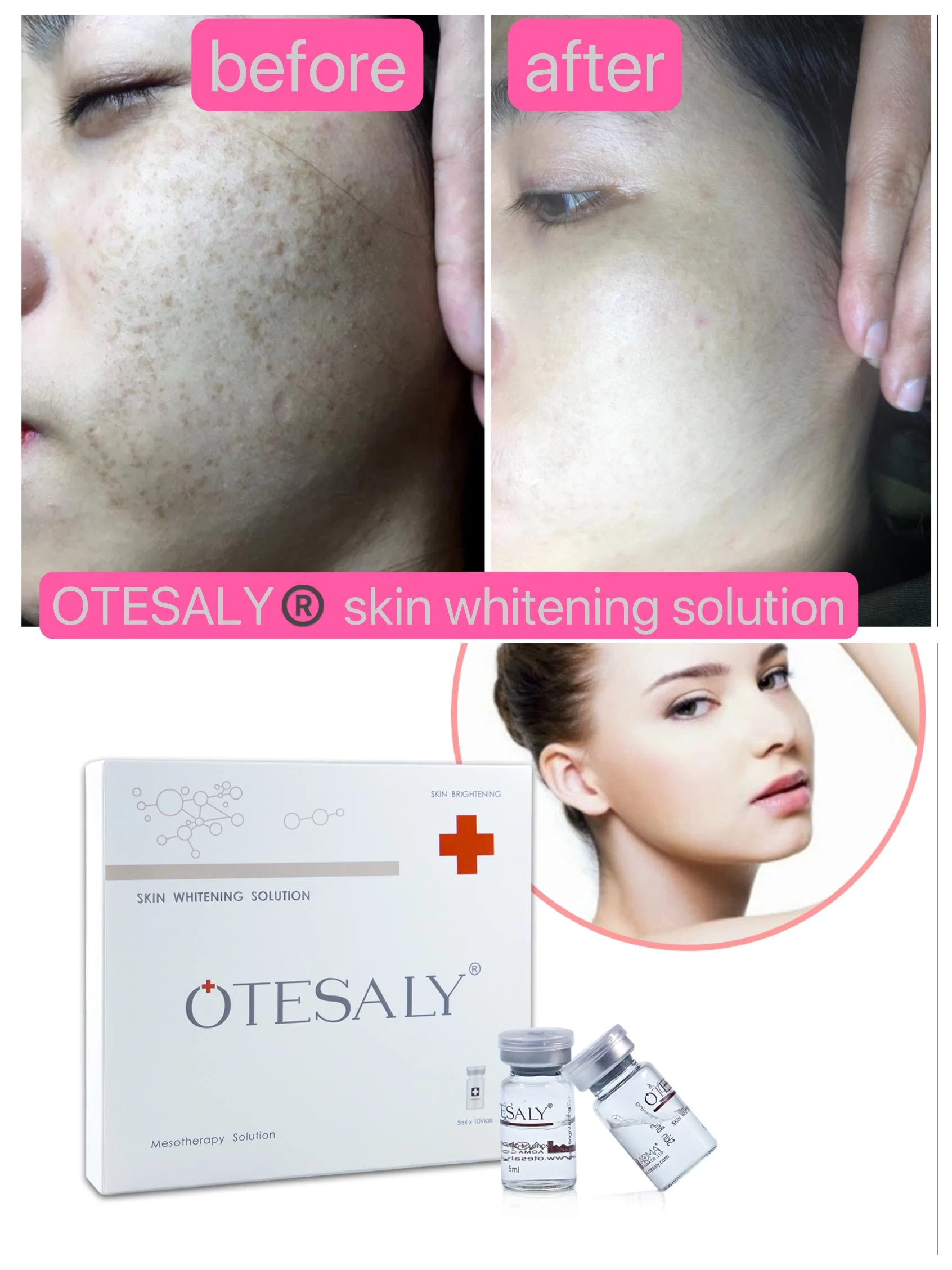 Mejor venta Otesaly Precio 50ml Otesaly Arbutina pigmentation Correcting Liquid Aclaramiento de la piel Mesoterapia Inyección de blanqueamiento corporal sérico