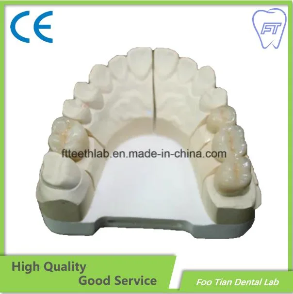 L'Orthodontie Traitement dentaire couronne en céramique de métal faites dans foo Tian Dental Lab à Shenzhen en Chine