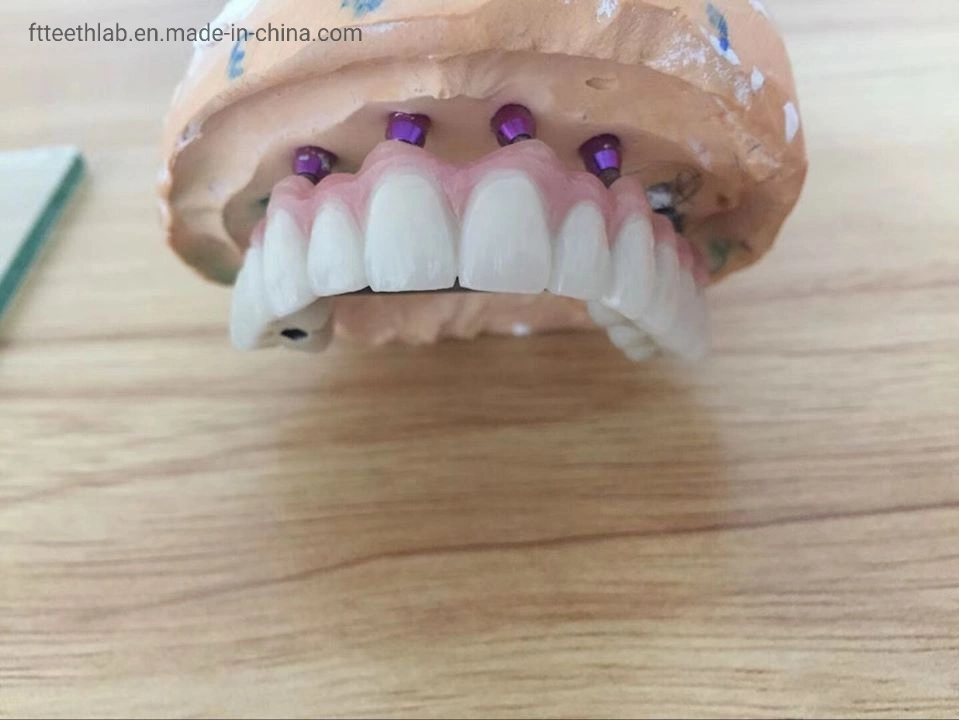 Dental Implant Bridge Made with Digital Scan Files Dental Implant