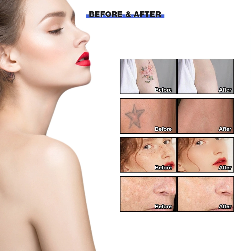 CE Q switched Nd Yag laser picoseconde Portable Beauté Soins de la peau de l'équipement