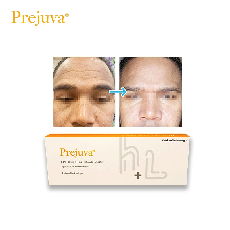 Prejuva Profhilo Solution injectable de rappel de la peau 3 2 64 mg 2ml Fille de la peau de remplissage Derma Booster