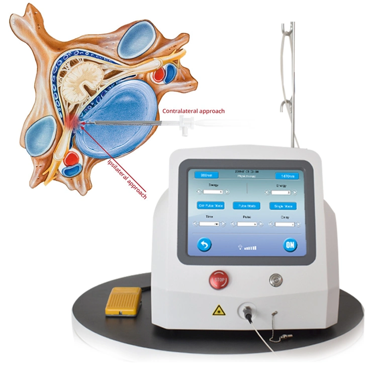 Laser der Klasse IV 980+1470nm Tragbares Pldd Diode-Lasersystem Chirurgie/Ausrüstung Für perkutane Laserdiskokomprimierung