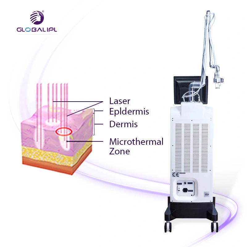 Système de laser CO2 fractionnelle /Dépose de l'Acné Machine/traitement des cicatrices