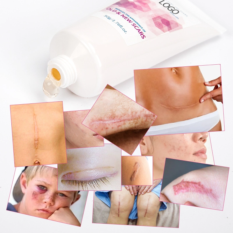 Hanf Silikon Behandlung Alte und Neue Stretch Mark Removal Creme Narbengel