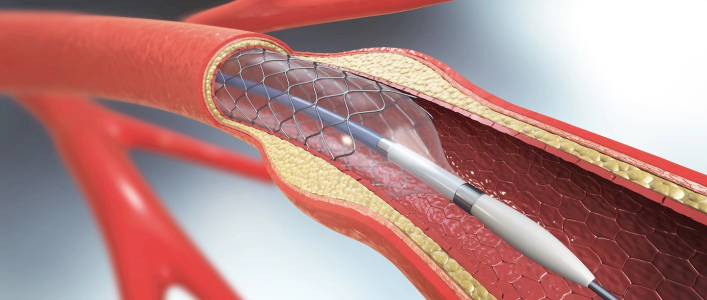 Médicos de alta calidad de elución de drogas cardiacas Stent coronario