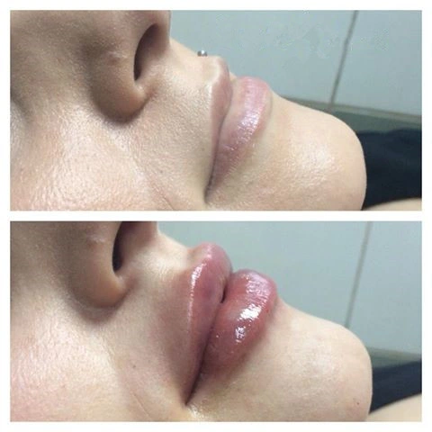 1ml 2ml ácido Hialurónico relleno Dermal Inyección fina/Derm/línea profunda ha Derm Filler