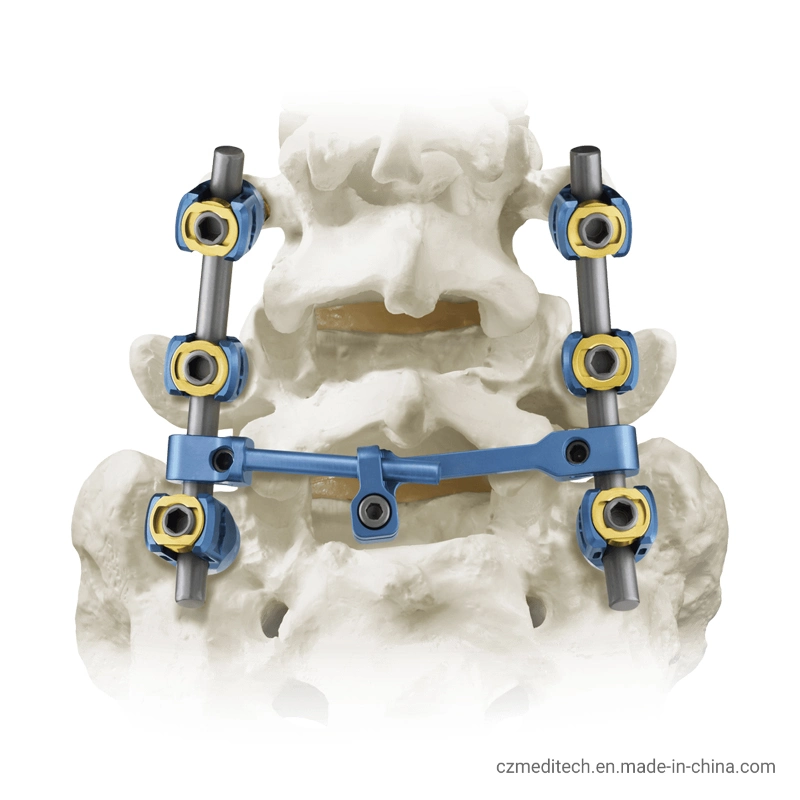 Precio competitivo Ortopedia Implantes quirúrgicos de la columna vertebral de tornillo de titanio pedículo