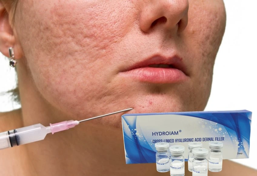 Hyaluronic Acid Injection Gel on Eyelids Fine Wrinkles Around Eye Smaller Wrinkles