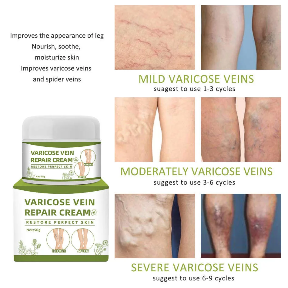 Ingredientes naturales, el Ungüento de vasculitis las Venas Varicosas Tratamiento Crema de Masaje