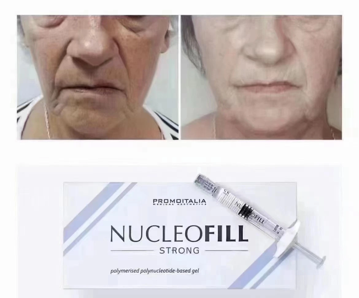 Versorgung Original Italien Nucleofill Injectable Dermal Filler Pn 2,5% Hyaluronic Säure Injektion Haut Lifting 7 Punkt Injektion Profhilo