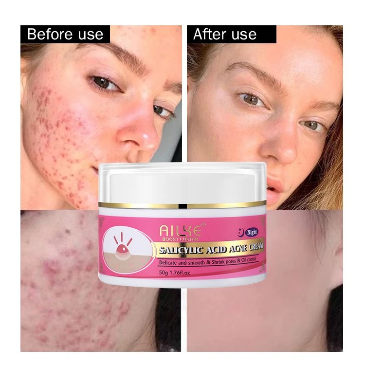 Natural Salicylic Acid Oil Control Moisturizing Acne Removal Face Cream Anti Acne Cream for Oily Skin