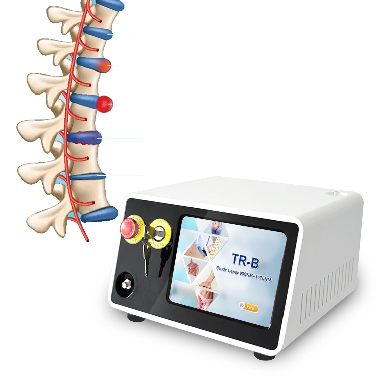 Dual Wavelength 980nm 1470nm Percutaneous Laser Disc Decompression for Chiropractor Doctors