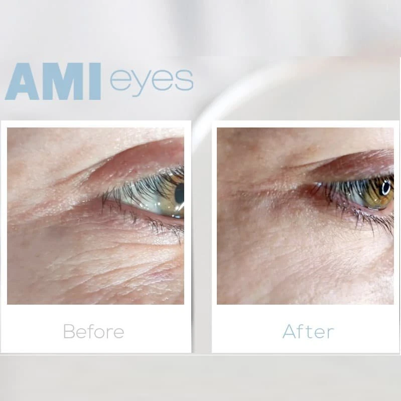 Eyes Mesotherapy Amieyes Skinbooster Pdrn Ami Eyes Teosyal Redensity 2 Lumi Eye for Crow's Feet Eyes Bags