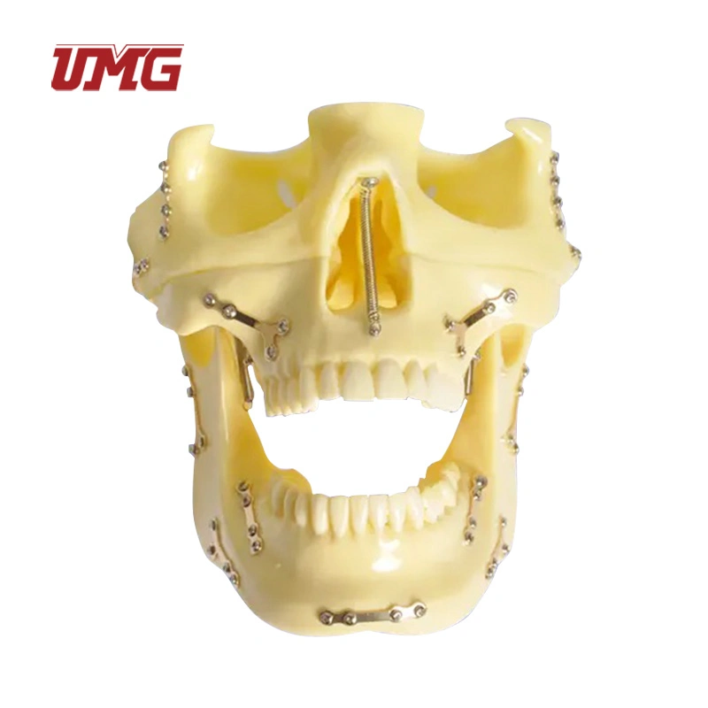 Fixed Bone Fracture with Titanium Plate and Ortho Implant Dental Skull Model