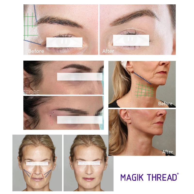 Magik Thread New Aesthetic Silhouette Pdo Thread Cog for Face Use