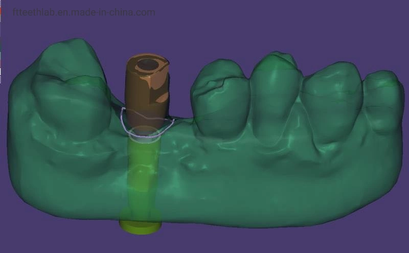 Dental Implant Bridge Made with Digital Scan Files Dental Implant